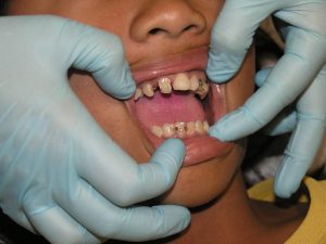 St Louis Dentist Say Goodbye to all your dental issues