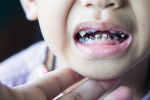 What is Bottle Tooth Decay?