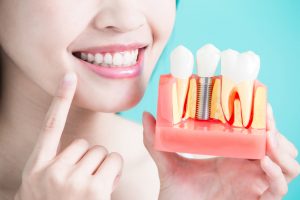 Dental Implants Guide To A Confident And Revived Smile