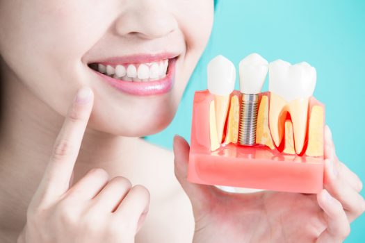 Dental Implants Guide To A Confident And Revived Smile