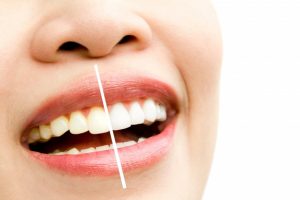 Cosmetic Dentistry Treatments Done To Improve Our Smile