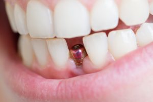 A Guide To Dental Implants