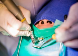 Facts you should know about the Root Canal Retreatment