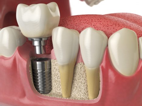 Important Facts You Should Know About The Dental Implants