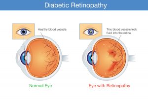 What are the symptoms of diabetic retinopathy?
