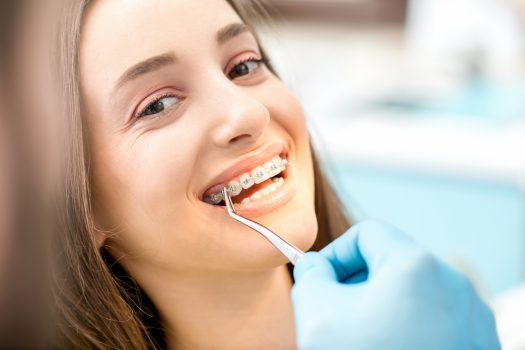 11 Essential Facts About Dental Braces That You Must Know