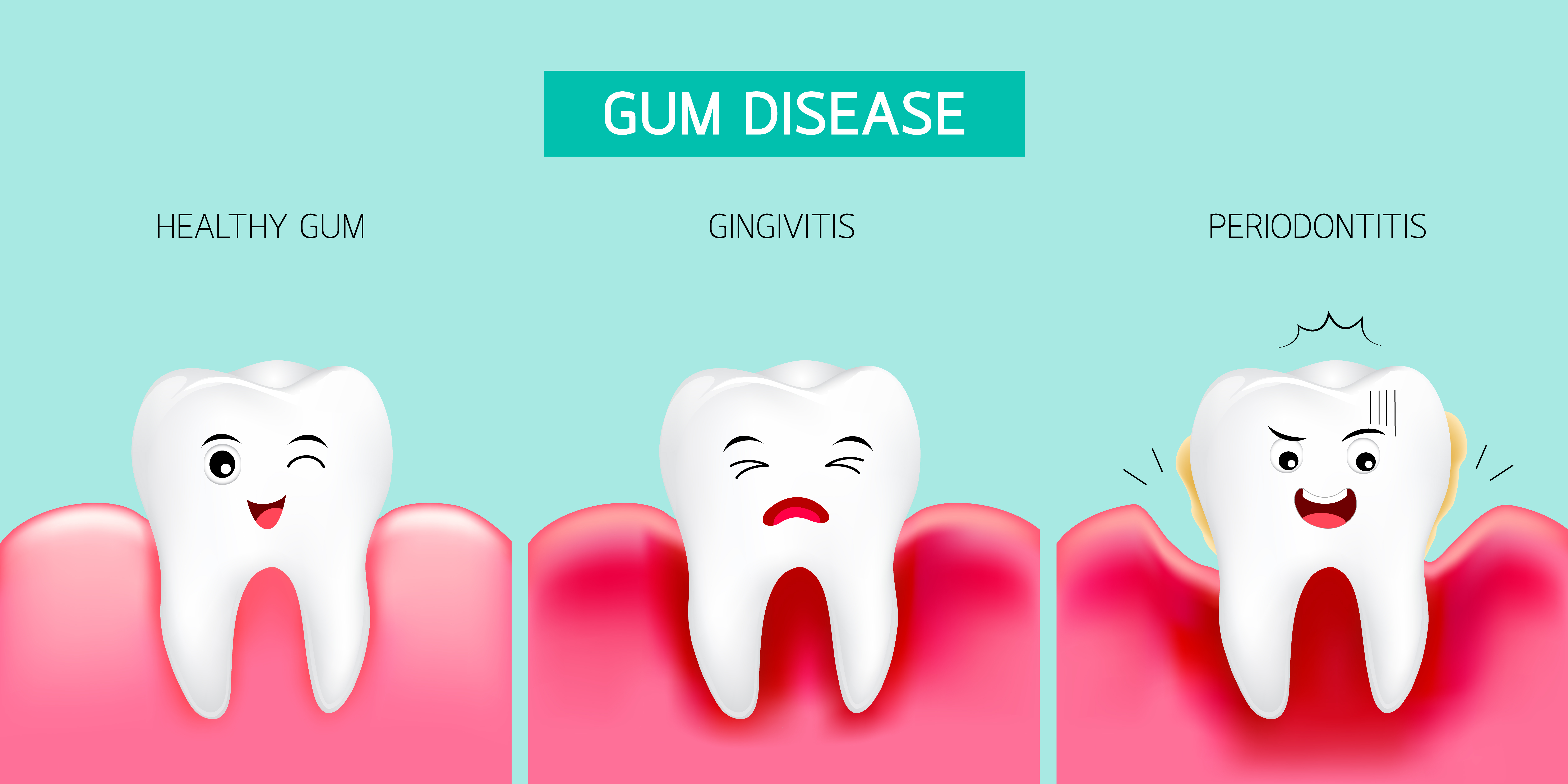 Periodontitis Causes Symptoms Prevention And Treatments