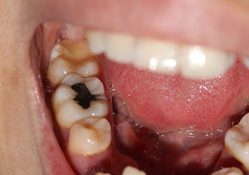 Decay Of Tooth How Can You Prevent It From Occurring