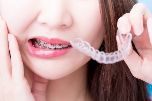 8 Teeth Problems And Reasons Why You Should Opt For Braces