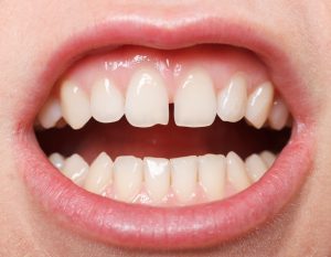 8 Teeth Problems And Reasons Why You Should Opt For Braces