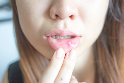Canker Sores Types Causes Treatments And Prevention