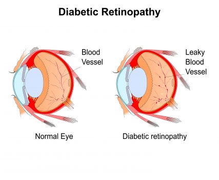 Diabetic Retinopathy Causes Symptoms Prevention And Cure