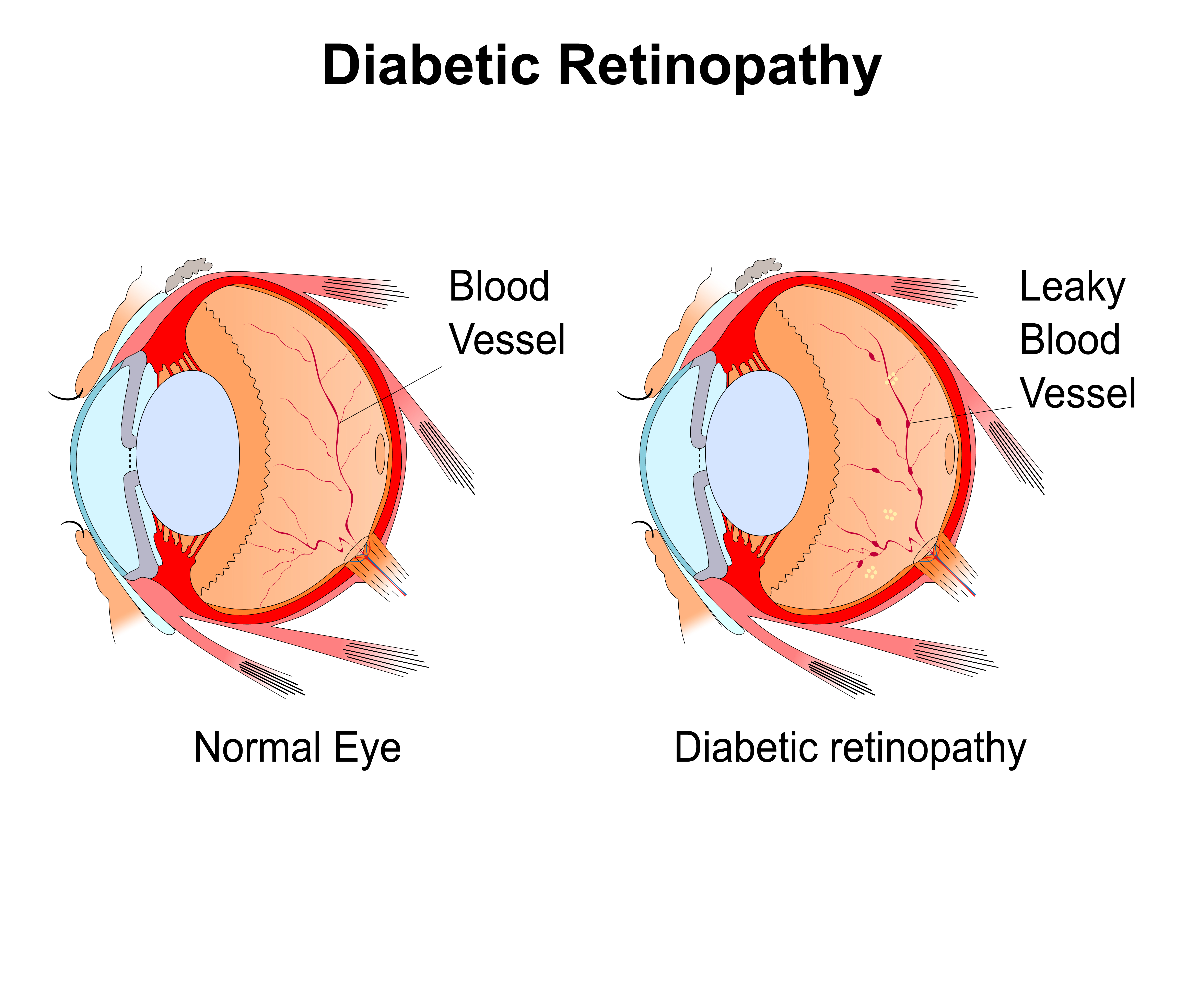 Diabetic Retinopathy Causes Symptoms Prevention And Cure