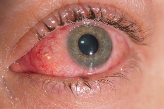 Top 7 Most Common Eye Conditions Symptoms And Treatments