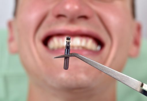 13 Reasons To Gift Yourself A Flawless Smile With Dental Implant