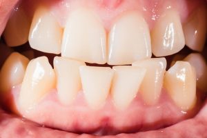 Malocclusion Its Causes Symptoms Prevention And Treatments