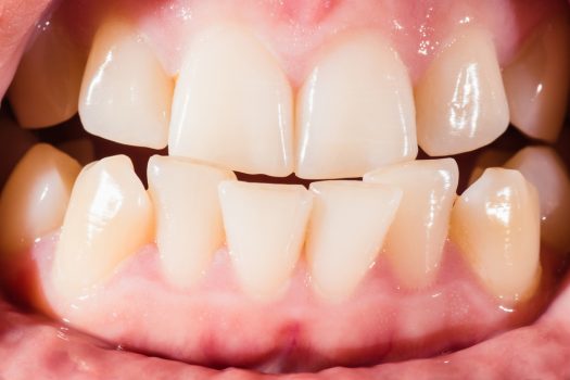 Malocclusion Its Causes Symptoms Prevention And Treatments