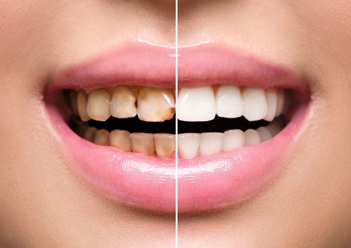 Teeth Whitening Useful Facts And Expert Recommendations