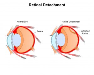 Retinal Detachment Causes Symptoms Types And Treatments