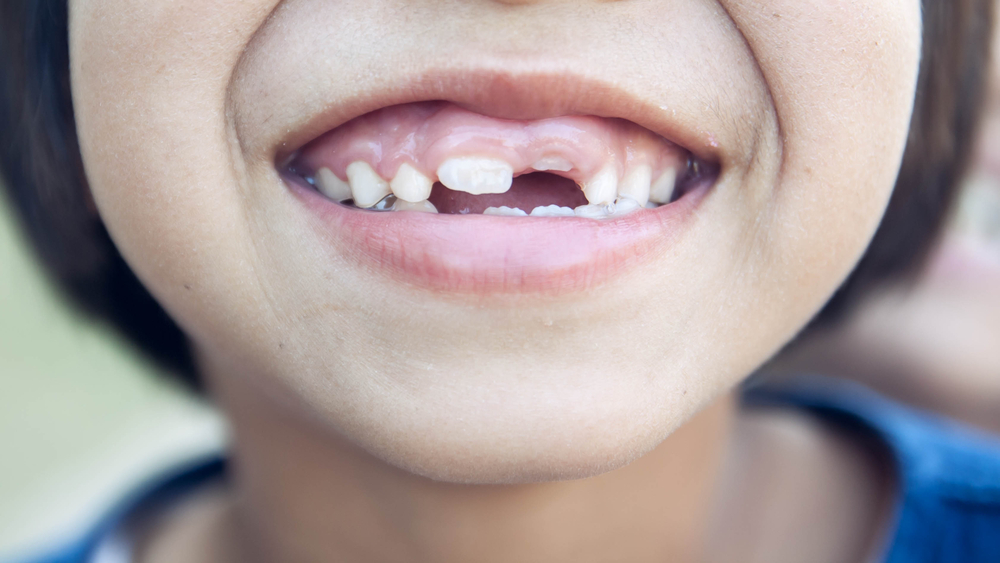 What Are The Causes Of Dental Emergencies Regarding Kids?
