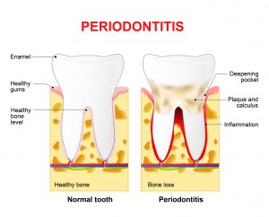 Pyorrhoea (Periodontitis) Advanced Stage Of Periodontal Disease