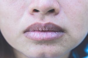 What Is Xerostomia Or Dry Mouth And Why Should You Not Ignore It?