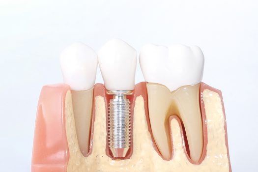 Dental Implants Procedure Advantages Disadvantages And Risks