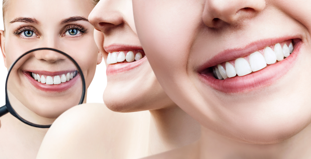 Introduction to Teeth Whitening: Things You Need To Know