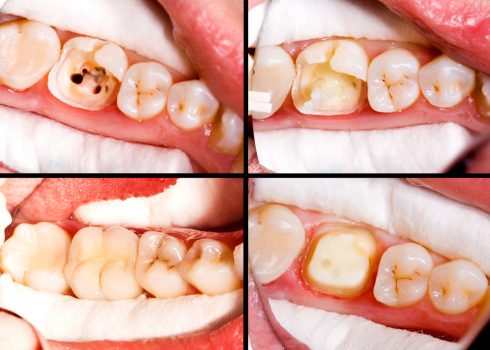 Composite Fillings And How Your Decayed Teeth Can Look Natural