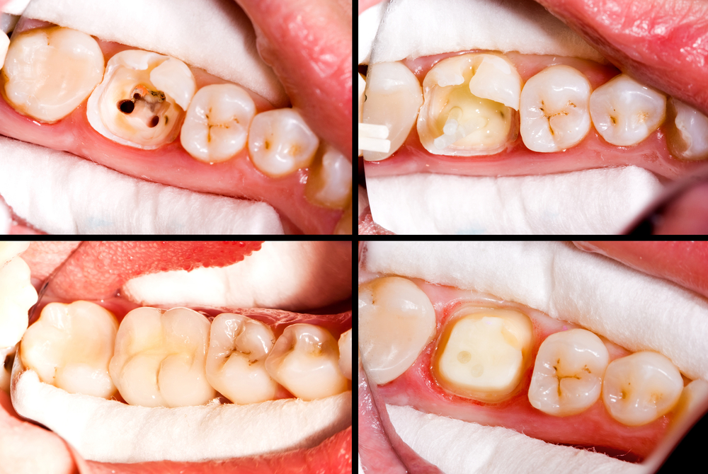 Composite Fillings and how your decayed teeth can look natural